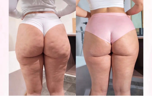 CelluLift Sculpt pro™-Appareil Anti-Cellulite & Vergetures professionnel maison